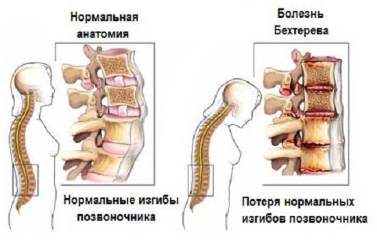 Болезнь Бехтерева – симптомы, причины, лечение